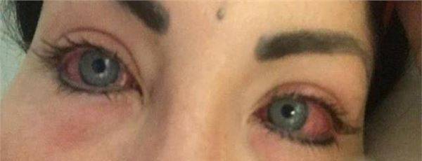 阿根廷32岁女模特花巨资改变眼睛颜色，结果导致眼睛失明！_图2