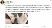 歌手张靓颖自曝营养不良