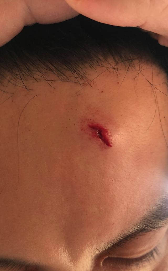 偶像不易千玺将受伤的手藏进袖子王俊凯用手盖伤王源险些晕倒