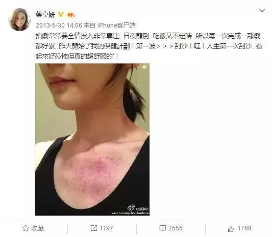 明星刮痧图鉴，看了都觉得疼…… - 360娱乐，你开心就好