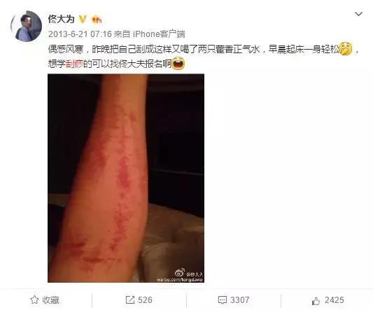 明星刮痧图鉴，看了都觉得疼…… - 360娱乐，你开心就好